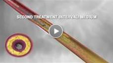 SOLIDWORKS Video Case Study - Cardiovasular Systems Incorporated - Medical